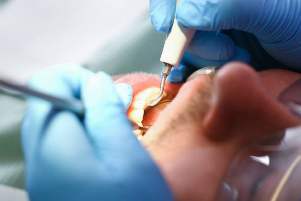 Best Emergency Dentist for Lost Fillings or Crowns in West Hollywood, CA