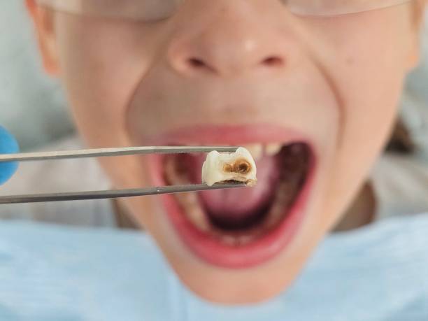 Best Emergency Dentist for Knocked-Out Tooth in West Hollywood, CA