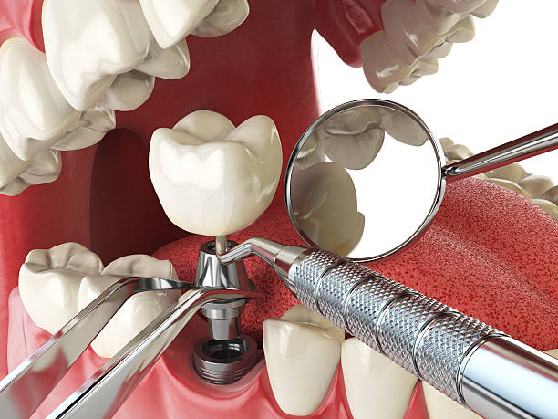 Best Emergency Dental Care for Abscessed Tooth in West Hollywood, CA